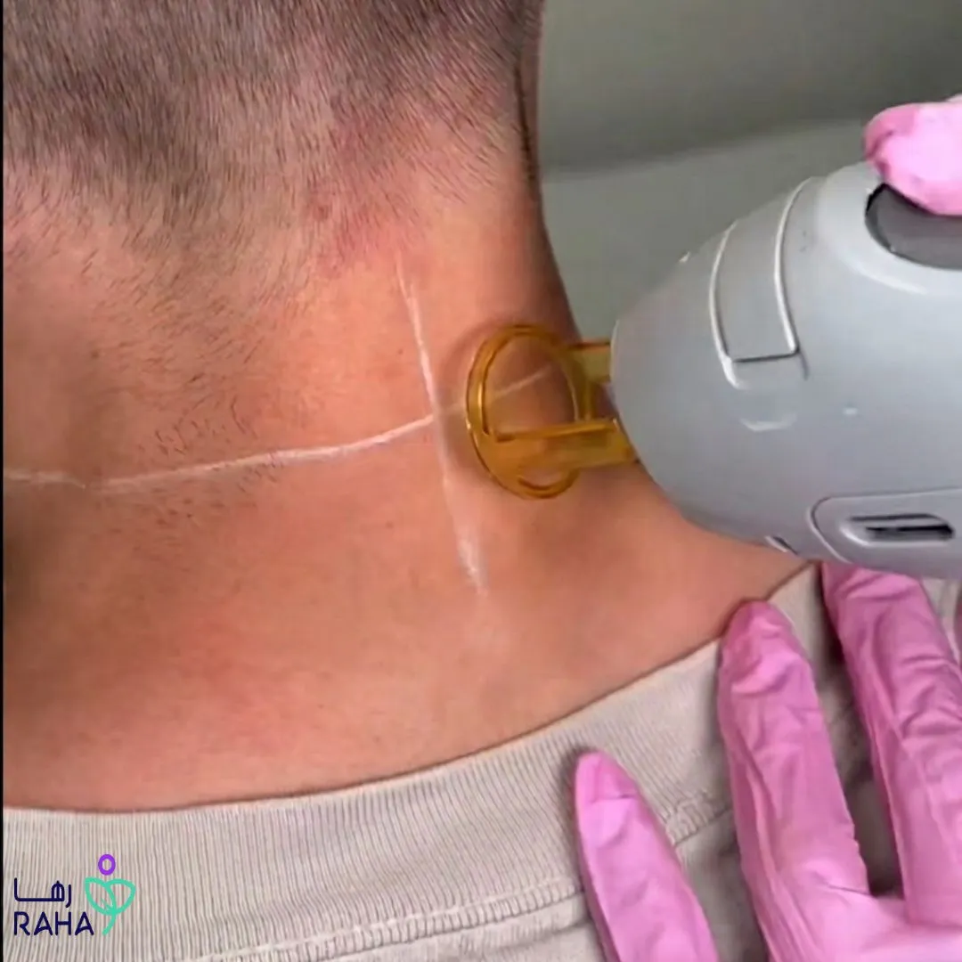 هل ليزر الجسم الكامل مناسب للرجال؟